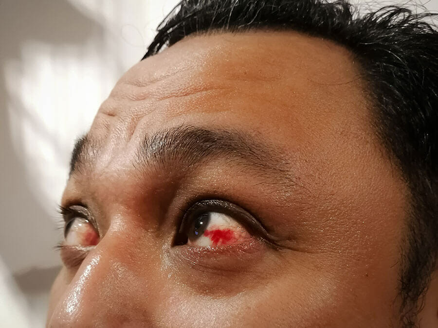 Scratched Eye in Bellflower